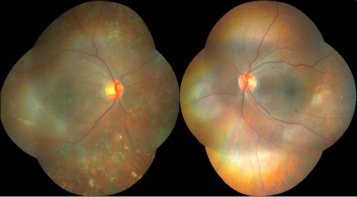 Case 1, Colored fundus photo, OU. A) Right eye after resolution of vitreous hemorrhage: Laser scars seen outside the vascular arcades, fibroproliferative membrane in the inferotemporal macula (white arrow), exudates associated with retinal thickening in foveal area . B) Left eye: few dot hemorrhages seen in superior and temporal retina, blot heorrhage in the inferior perifoveal area, exudates seen in the temporal macula.