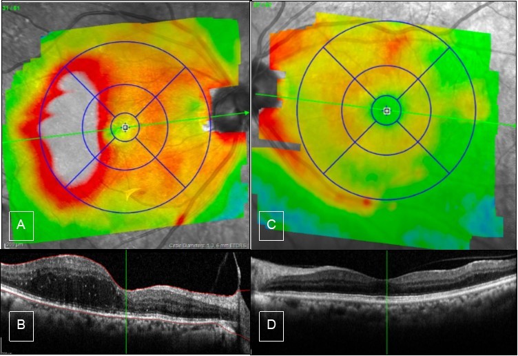 Case 1, OCT, OU. A & B) Right eye showed edema of the temporal macula involving fovea, there is PVD from the macula but still attached to the optic nerve. C & D) Left eye has partial PVD, otherwise it is unremarkable.