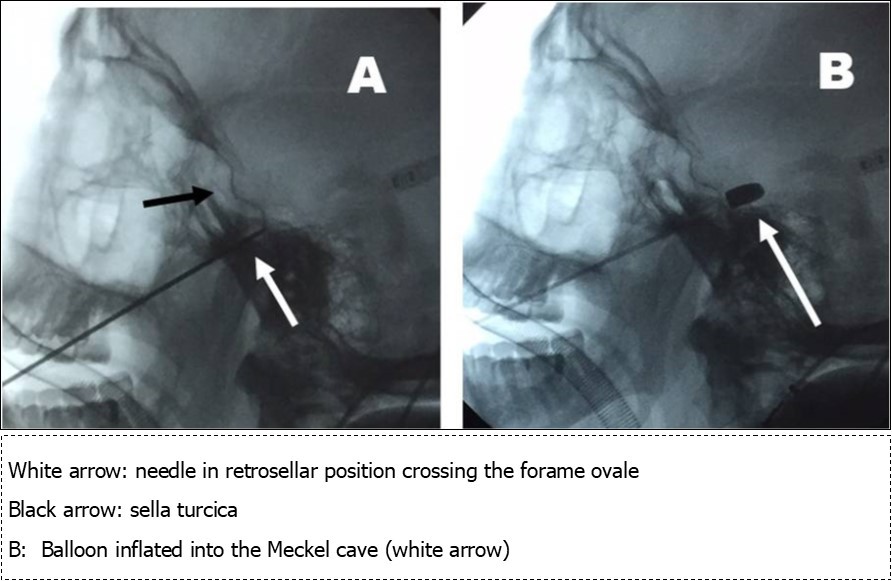 A: needle positioning into the Meckel cave (retrosellar position)