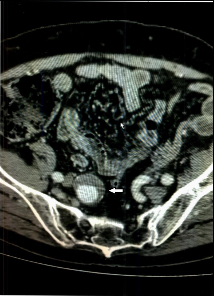 Case 1 – Right Internal Iliac Aneurysm