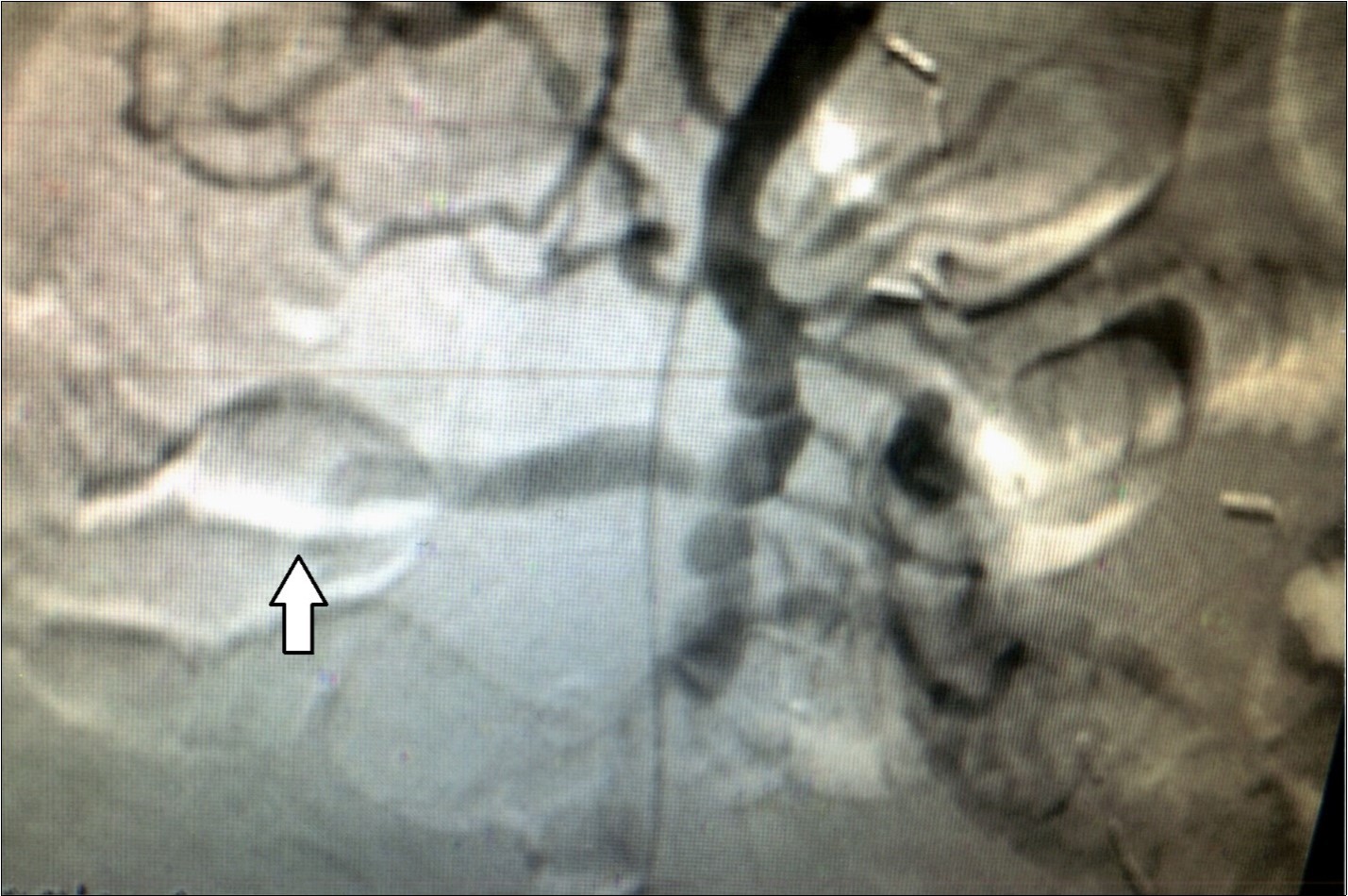 Case 2 – Superior Mesenteric Artery Branch Aneurysm.
