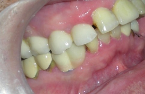 Definitive Prosthesis