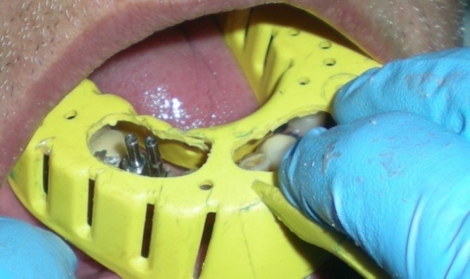 Plastic stock tray with access window over the copings.