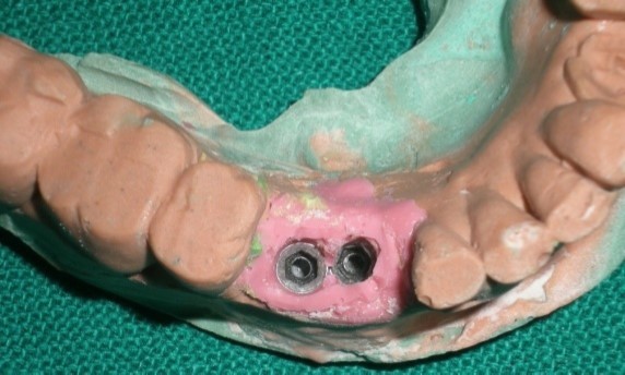 Master cast with artificial gingiva
