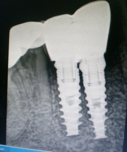 Radiograph verifying the fit of the abutment