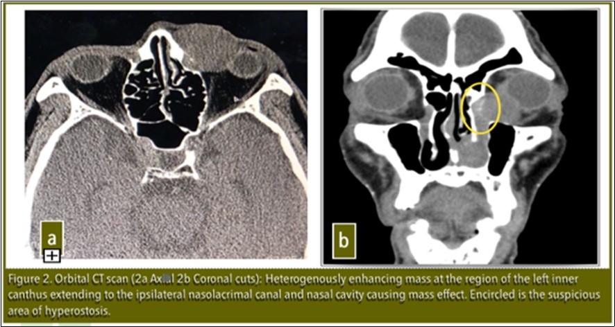Orbital CT scan ( 2a Axial. 2b Coronal cuts): Heterogenously enhancing mass at the region of the left inner canthus extending to the ipsilateral nasolacrimal canal and nasal cavity causing mass effect. Encircled is the suspicious area of hyperostosis.