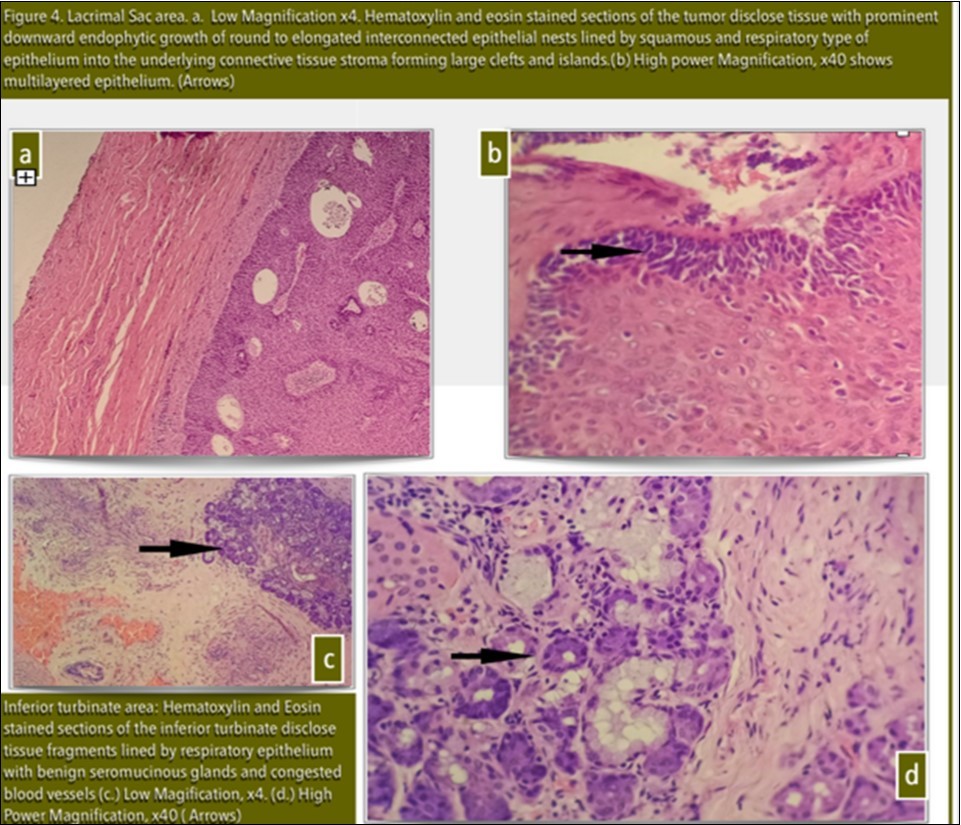 Lacrimal Sac area. a. Low Magnification x4. Haematoxylin and eosin stained sections of the tumor disclose tissue with prominent downward endophytic growth of round to elongated interconnected epithelial nests lined by squamous and respiratory type of epithelium into the underlying connective tissue stroma forming large clefts and islands. (b) High power Magnification, x40 shows multilayered epithelium. (Arrows)