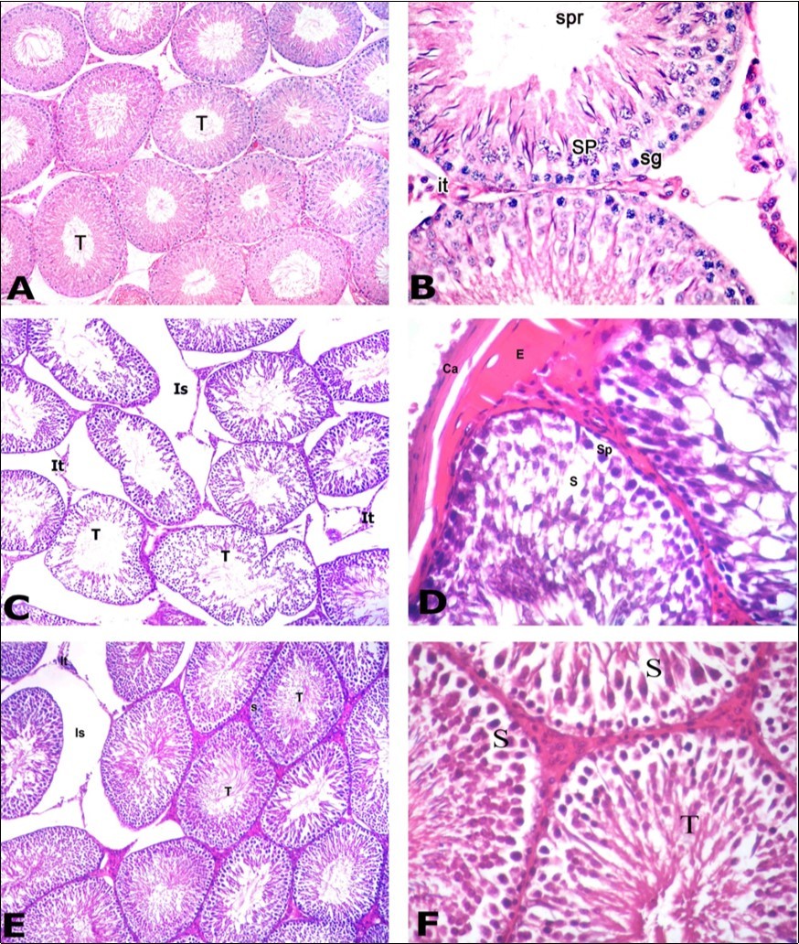 Photomicrographs of testis sections of the different groups: A) Control group showing round seminiferous tubules (T) with regular contour. Tubules appear packed together with narrow interstitial space. B) Higher magnification of the previous section showing the different spermatogenic cells of the germinal epithelium including: spermatogonia (sg), primary spermatocytes (SP) and sperms (spr). Cluster of interstitial cells of Leydig (It) present in the narrow interstitial space. C) PTU-treated group showing loss of normal round seminiferous tubules (T) that appear with irregular contour. Widening of the interstitial space (Is) through which remnants of interstitial cells of Leydig (It) can be recognized. D) Section in the PTU treated group showing thick capsule (Ca) with subcapsular acidophilic hyaline material deposition (E). Germinal epithelium showed gap spaces (s) present among cells. Primary spermatocyte (Sp). E) PTU and LC treated group showing restoration of many seminiferous tubules (T) to their normal shape with regular contour. Most tubules restored its tight junction however there is still widening in the interstitial space (Is), remnants of Leydig cells (It) and gap spaces (s) between spermatogenic cells of some tubules. F) Section in the PTU and LC treated group showing that germinal epithelium begins to restore its normal cellular composition. Seminiferous tubules (T) contained whorls of sperms. However, gap spaces (S) between epithelial cells are still present. A C & E: H&E X 100; B D &F: H&E X400