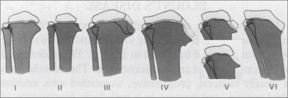 Langenskiold staging describes six radiographic stages of the disease based on the degree of epiphyseal depression and metaphyseal fragmentation of the proximal medial tibial epiphysis 13.