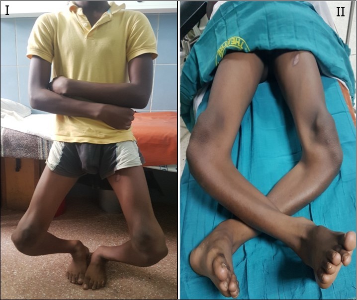 Pre-operative photograph of the patient, standing I, and lying, II.