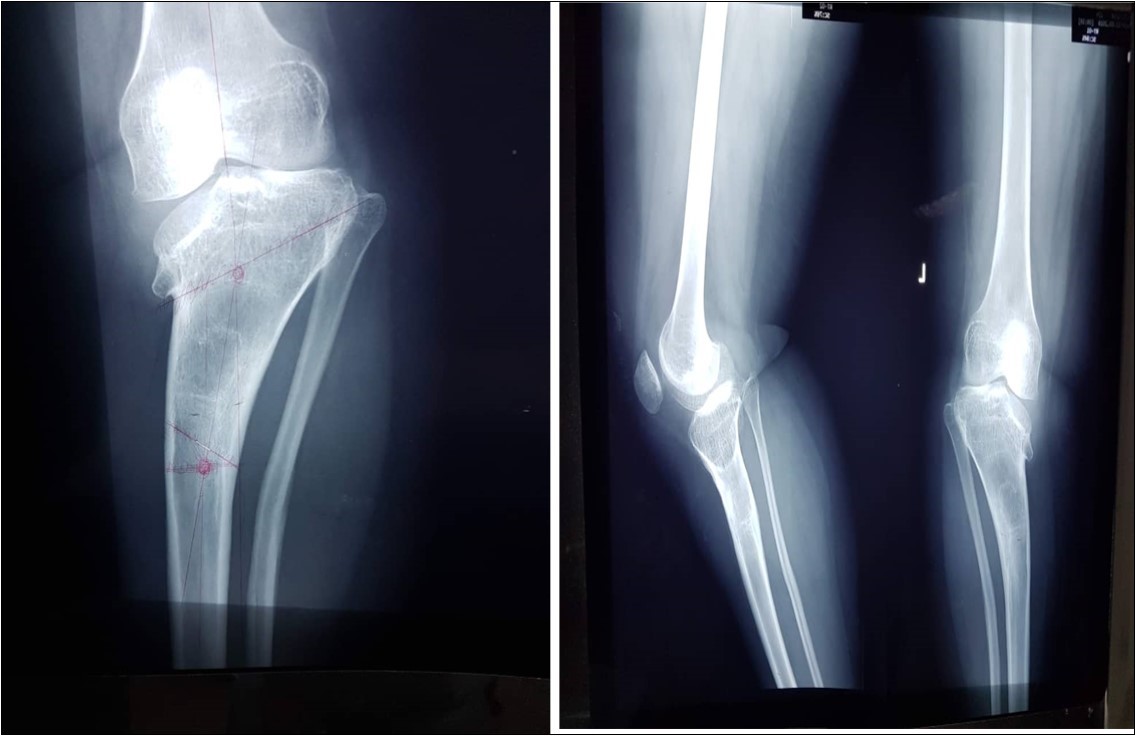 Fig showing pro-operative radiograph of the left tibia and fibula
