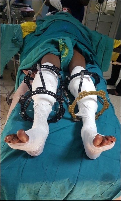 Immediate post-operative picture of the patient lying on the operating table.