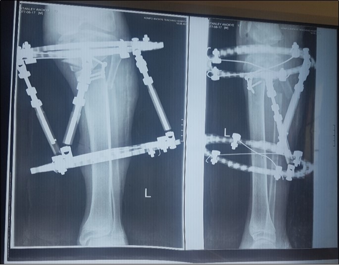 Post-operative x-ray showing the proximal tibia and the fibula osteotomy as well as the Taylor Spatial Frame.
