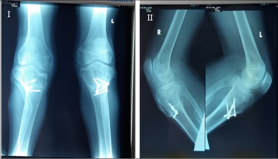X-ray of both knees of the patient anteroposterior view, I, and lateral view II, 2yrs post operatively showing correction of the bilateral tibia vara with 8-plate and screws in situ.