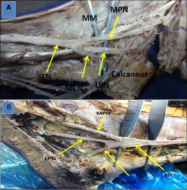 Photographs of the ankle region in (A) and (B) showing a single medial calcaneal nerve (MCN) originating from the tibial nerve (TN) deep in the tarsal tunnel.