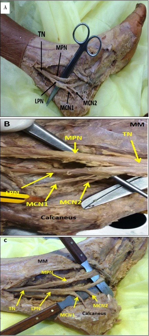 Photographs of the ankle region in (A), (B), and (C) showing two medial calcaneal nerves (MCNs)originating from the lateral plantar nerve (LPN).