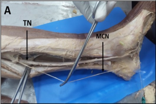 Photograph of the left leg (A) showing one medial calcaneal nerve (MCN) originating from the tibial nerve (TN) high up in the back of the popliteal region.