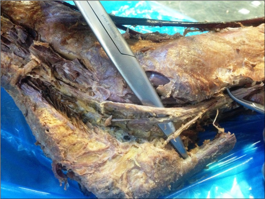 Photograph of a left leg (B) Showing one medial calcaneal nerve (MCN) originating from the tibial nerve (TN) outside the tarsal tunnel.MM (Medial malleolus) ,MT (Medial tubercle)