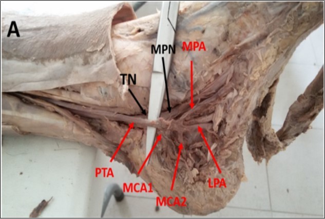 Photograph of the left ankle region showing double medial calcaneal arteries (MCAs) branching from the posterior tibial artery (PTA). MPA: Medial plantar artery, LPA: lateral plantar artery, TN: tibial nerve, MPN: medial plantar nerve.