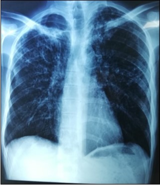 Pneumoperitoneum on chest X Ray