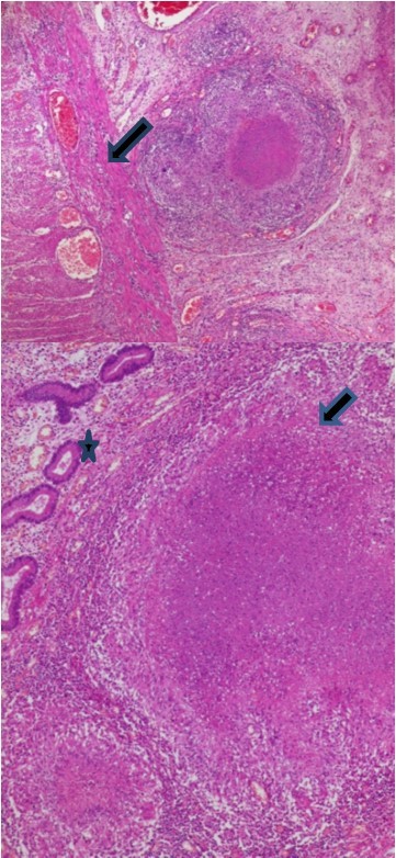 Epithelioid granuloma and giant cells (Arrow) with caseous necrosis (Star)