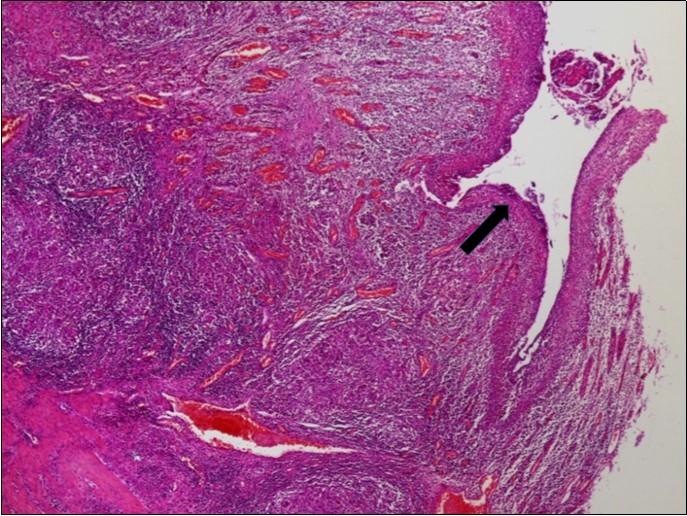 Signs of acute peritonitis in the intestinal mucosa