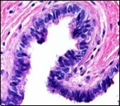 Ciliated cutaneous cyst lined by pseudostratified ciliated columnar epithelium and a supporting fibro-connective tissue stroma 11.