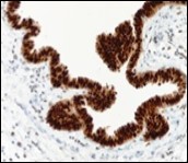 Cutaneous ciliated cyst with nuclear immune reactivity to progesterone receptors (18).