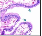 Ciliated cutaneous cyst with an undulating layer of ciliated cuboidal epithelium and supporting fibrous tissue framework (12).