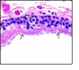 Ciliated cutaneous cyst with a coating of plump, ciliated columnar epithelium and a circumscribing fibro - connective tissue (12).