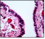 Cutaneous ciliated cyst with a ciliated, pseudostratified columnar epithelium and vascularized fibrous tissue stroma (13).