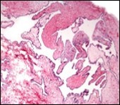 Cutaneous ciliated cyst with incomplete intervening septa and a lining of attenuated, ciliated epithelium along with supporting fibrous tissue (13).