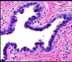 Cutaneous ciliated cyst with a ciliated cuboidal lining, undulations within the cyst cavity and a wall comprised of fibro-connective tissue (14).