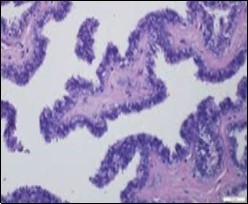 Cutaneous ciliated cyst with papillary structures, a coating of ciliated columnar epithelium supported by a connective tissue framework (15).