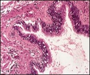 Cutaneous ciliated cyst with incomplete septa and a layer of pseudostratified, ciliated columnar epithelium surrounded by fibrous tissue (16).