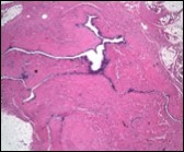 Cutaneous ciliated cyst with abundant, circumscribing fibro-connective tissue and a cyst lined by ciliated columnar epithelium (17).