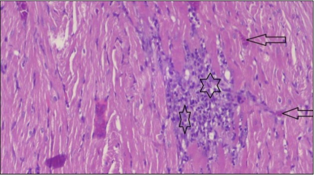 Photomicrograph of heart section of an obese rat showing large number of inflammatory cells (star), degeneration muscles fiber, circle and congested Blood vessels (arrow), (H&E) (400X).