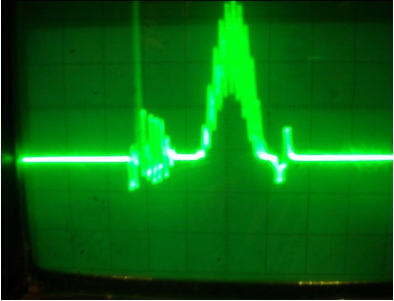 Oscillograph of the both transistors collector voltage in the physical model of the system (7) corresponding to the interaction process between two FPU recurrences corresponding to the interaction dynamics of the electron current Ielectron and that of the phonon current Iphonon. The electron current energy prevails. Vert axis milli sec/cm, Horiz axis-3volts per cm.