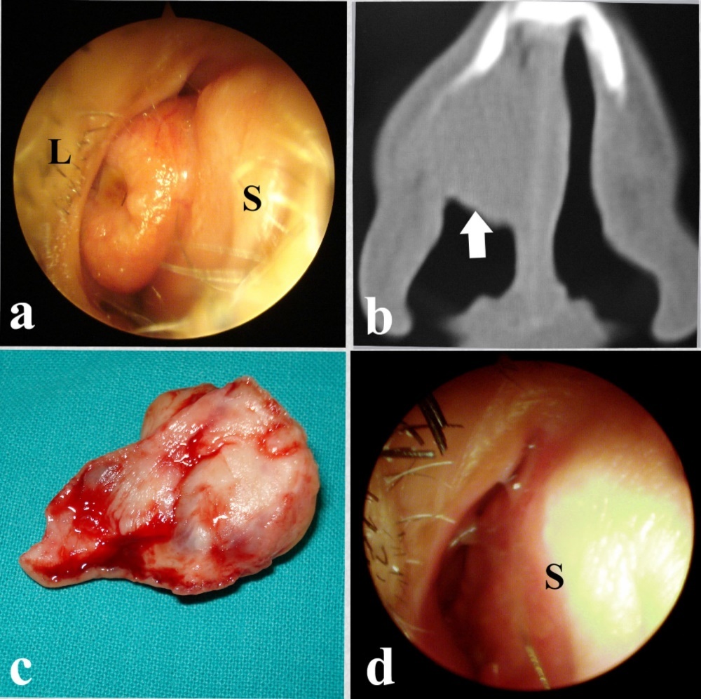 a-Endoscopic view of the adenoma. S: Septum, L: Lateral wall, b-Coronal CT scan showing the adenoma (arrow), c-The excised adenoma, d-Complete healing of the septum (S).
