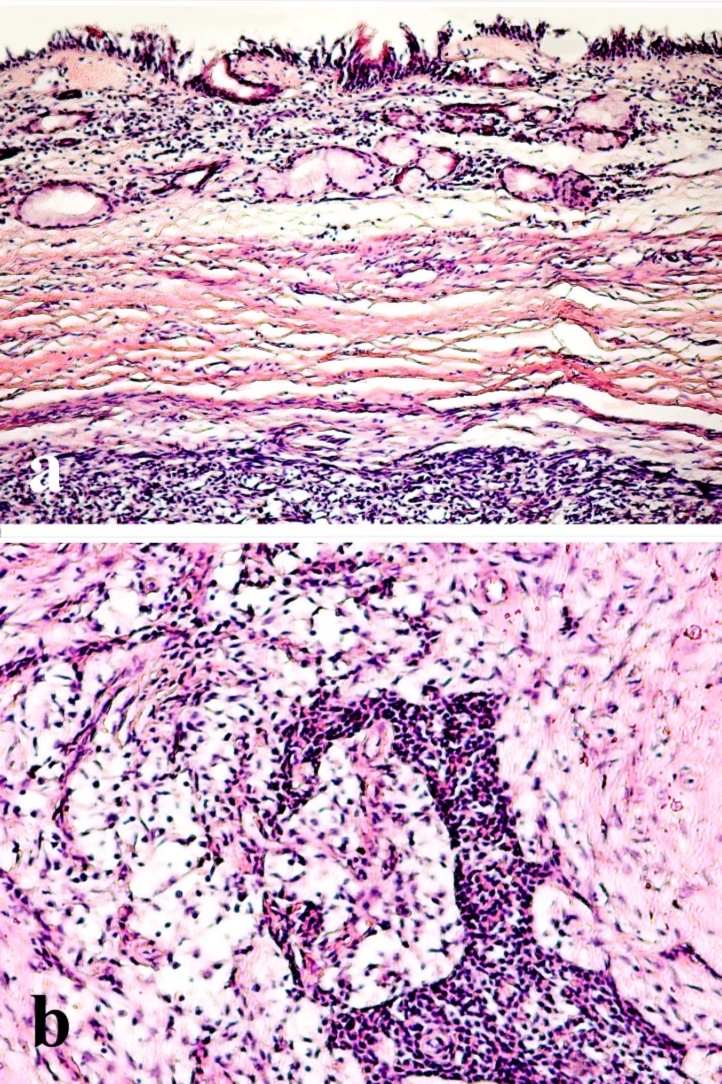 a-Histopathologic section showing a benign non-encapsulated tumor under respiratory epithelial lining b-The tumor is composed of polygonal epithelial and spindle-shaped myoepithelial elements in a myxofibrous stroma (H&E, x200