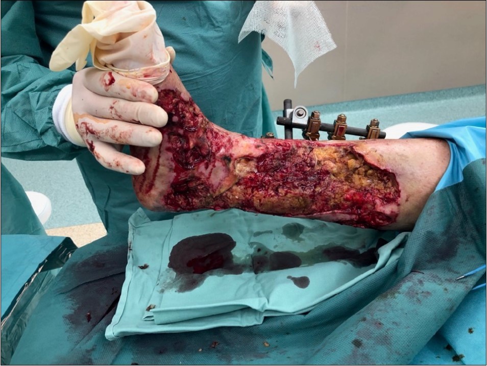 19 February. performed necrectomy, vitalization of subcutis, application negative pressure wound therapy