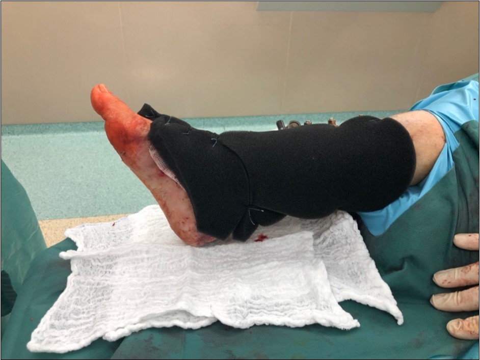 19 February. application of negative pressure wound therapy Vivano. application of polyurethane foam, foil, central port with tubing