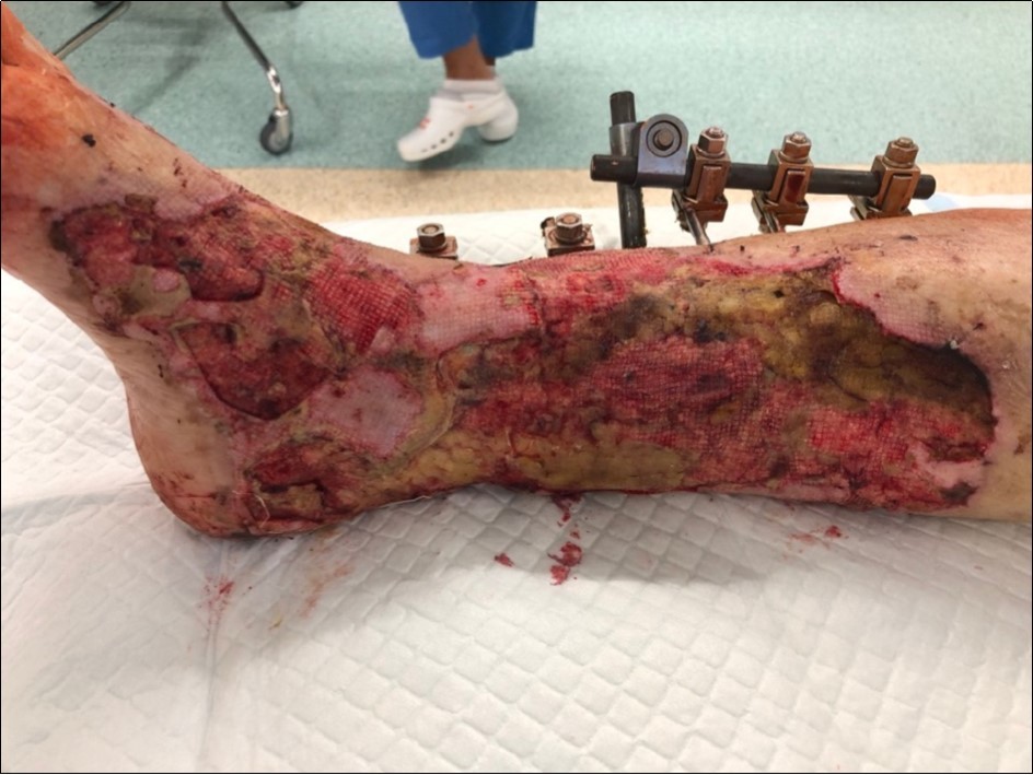 4 March - after one removing the vacuum therapy. demonstration of subcutaneous granulation. wound dressing changing every 5-6 days