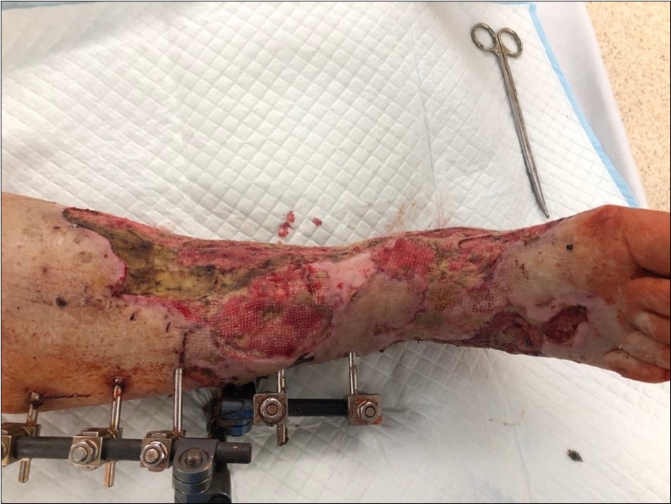 4 March - after one removing the vacuum therapy. demonstration of subcutaneous granulation. wound dressing changing every 5-6 days