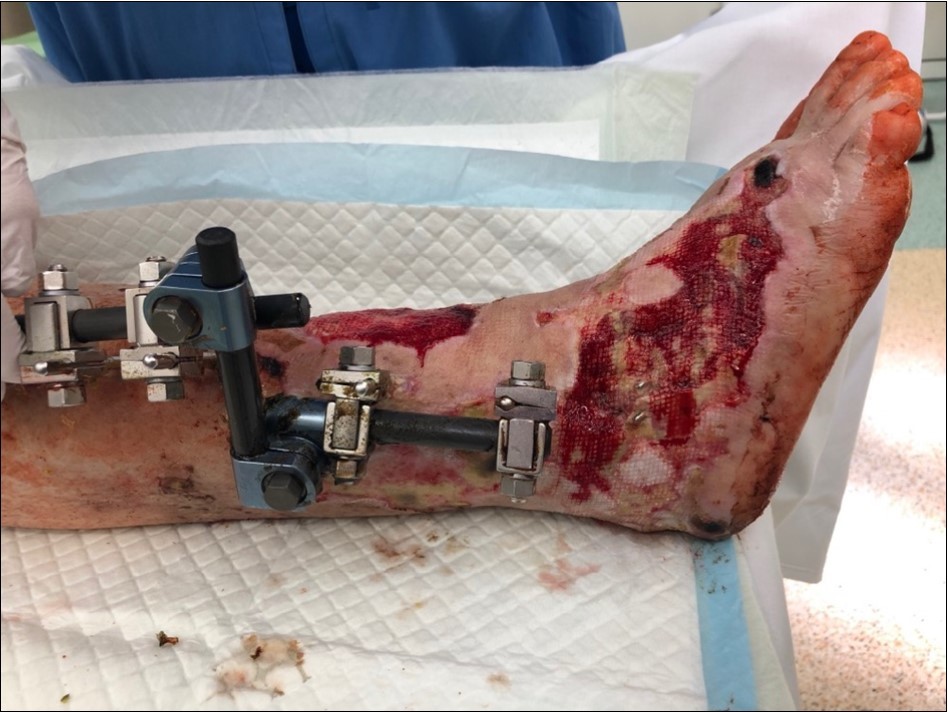 4 March - after one removing the vacuum therapy. demonstration of subcutaneous granulation. wound dressing changing every 5-6 days