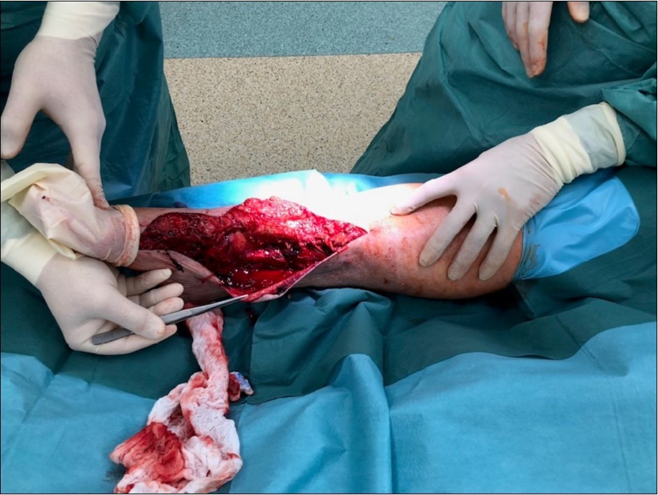 22 January – primary surgical treatment in the operating room