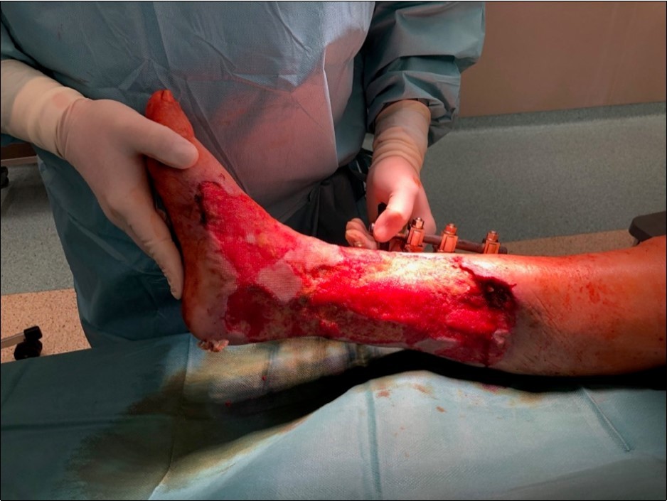 19 March. Defect of limb already clean with granulation ready for application of dermoepidermal graft