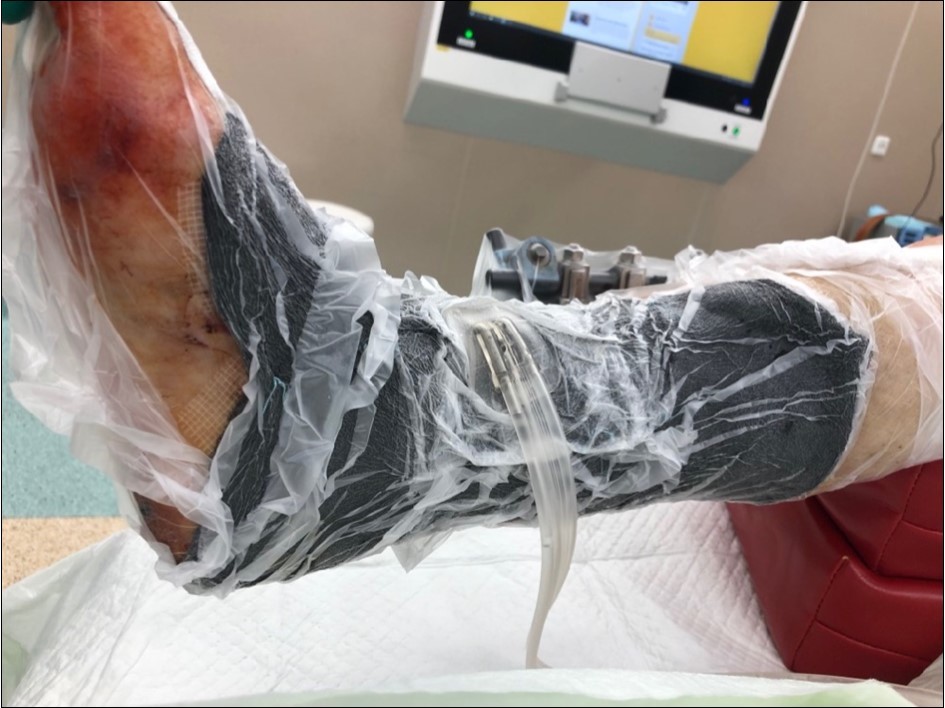 application of dermoepidermal graft with vacuum therapy of 90 mmHg