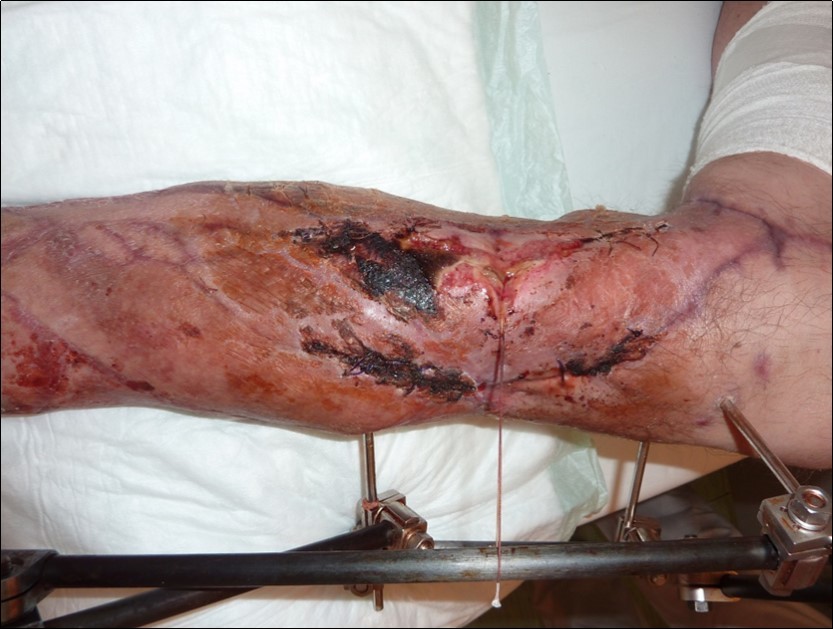 January 2016. resection of the tibial avital cortica and resuture