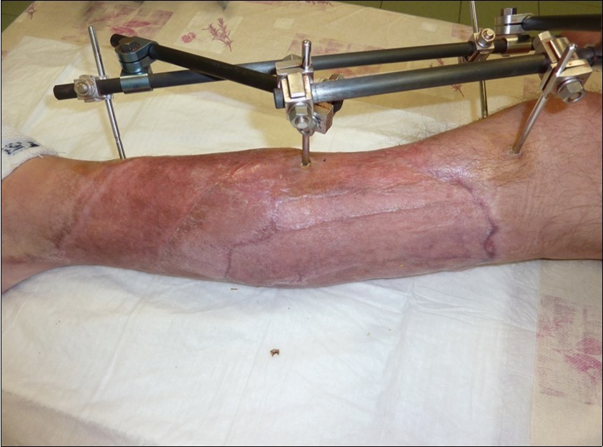 Jun 2016. skin cover completely healed. 9 months from the injury to heal soft tissues